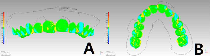 Deviation analysis which shows PE at pit, fissure, proximal area and NE at cusp (maxillary cast of model no. 10)