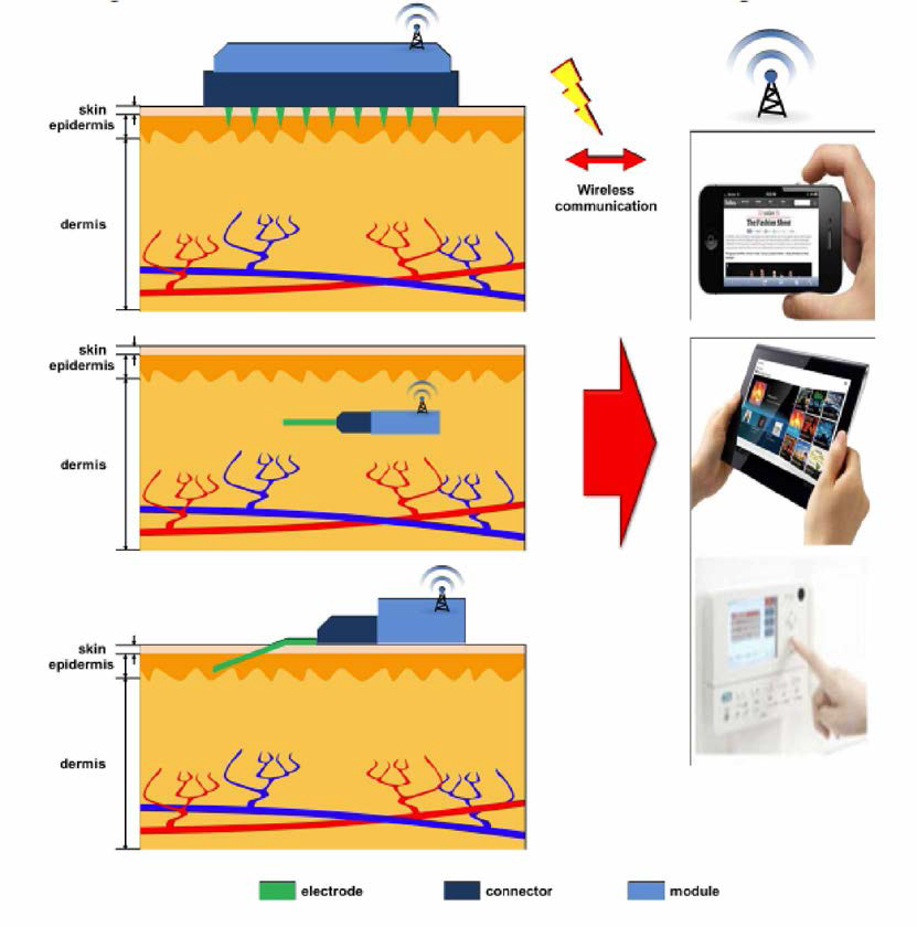 Wearable glucose sensor의 개념도 (패치형，완전 임플란트형，패치형)