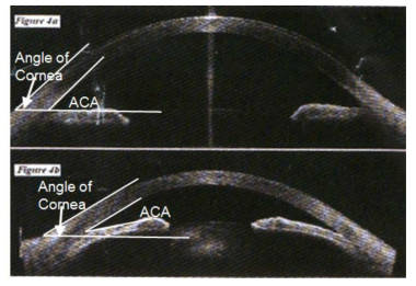 초음파 biomicroscope 각막부위각도 측정