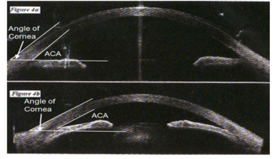 Ultrasound Biomicroscopy Image를 이용한 전방각과 각막 주변부 각도 관계 분석