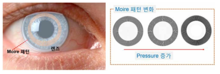 콘택트렌즈의 모아레 패턴이 안압상승으로 간섭 모양이 바뀜