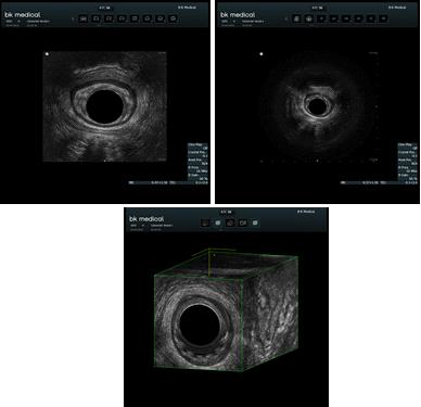 BK medical 의 영상들이며, 위 그림의 상단 왼쪽그림은 16MHz로 본 영상으로 돼지의 internal spincter와 external spincter가 clear하게 보이고 360도 영상의 끊임이 발생하지 않고 2cm 깊이까지 잘 보임