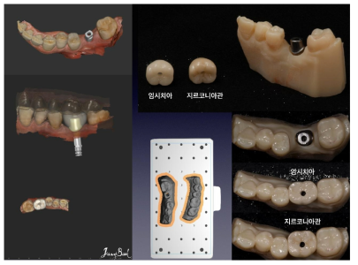 치과용 CAD S/W로 치아의 형태를 디자인하고, 3D프린트 및 밀링 과정을 통하여 제작한 기공물을 임상 평가전에 미리 준비함