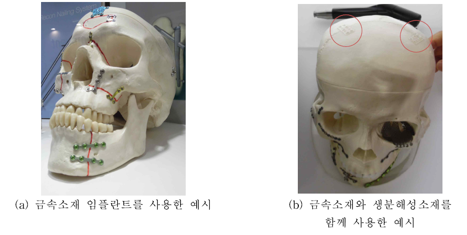 두개악안면 수술에 사용되는 임플란트 예시