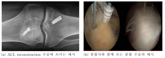 골절 수술에 사용되는 임플란트 예시