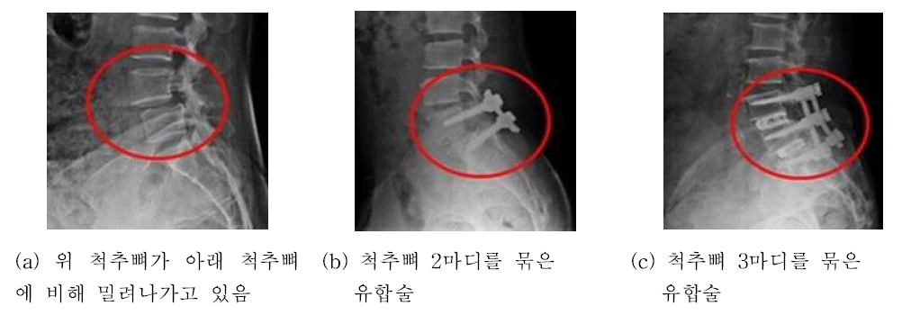 정형외과 척추 유합술 시술 예시