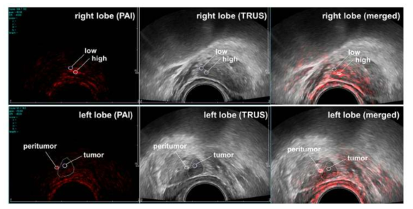 개발된 장비를 이용하여 Human study를 통해 획득한 경직장 초음파/광음향 융합 영상