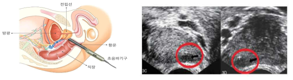 경직장 초음파 검사 방법 예시(좌측) 및 경직장 초음파 영상을 이용한 전립선 암 진단 영상의 예시(우측). 전립선암은 붉은색 원으로 표시하였음