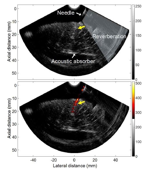 광음향 영상의 유효성 평가를 위한 닭가슴살 내부 19 gauge needle 영상: (위) 초음파 영상, (아래) 초음파/광음향 융합 영상. 노란색 화살표는 닭가슴살 내부 needle path를 가리킴