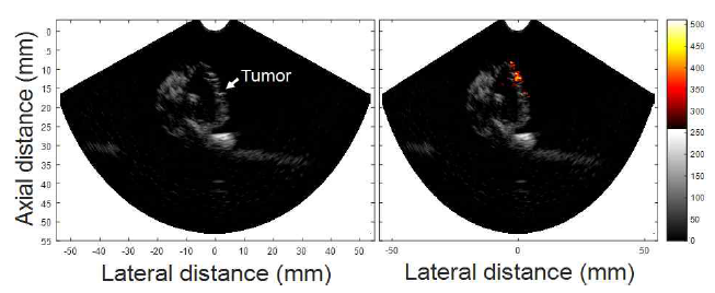 경직장 초음파/광음향 융합 프로브를 통해 획득된 Xenograft tumor 마우스 모델에서의 (왼쪽) 초음파 영상, (오른쪽) 초음파/광음향 융합영상