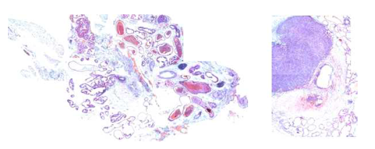 전립선 암 orthotopic 질병 모델에서의 종양의 H&E staining image