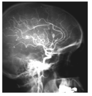 요오드 조영제를 사용한 중대뇌동맥 조영 X-ray