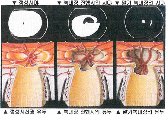 시신경의 손상(녹내장 경과에 따른 유두의 형태 변화)