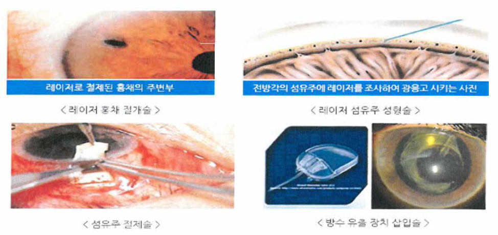 녹내장의 수술법