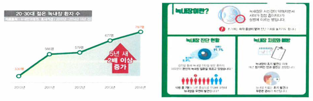 누네안과병원 20, 30대 녹내장 환자 수 조사결과 (서울 신문 2015.3.4 보도 자료, 한국녹내장학회 녹내장 바로알기 포스터)