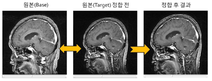 MRI 영상에서의 포인트 기반 정합 결과 예