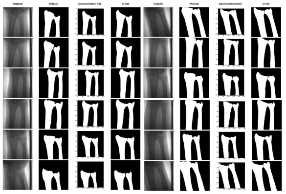 Deconvolution-Net과 U-Net 모델간 Ulna 및 Radius 뼈 추출 결과의 비교 (Original : 원본 영상, Manual : 수동 추출 결과, Deconvolution : Deconvolution-Net을 통한 추출 결과, U-Net : U-Net 모델을 통한 추출 결과)