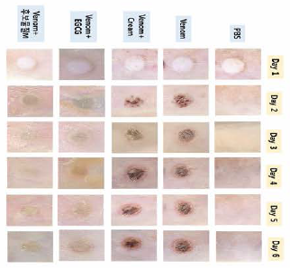 Neutralizational effect of jellyfish toxicity using high concentration of EGCG cream and candidate substance M cream - 6th days