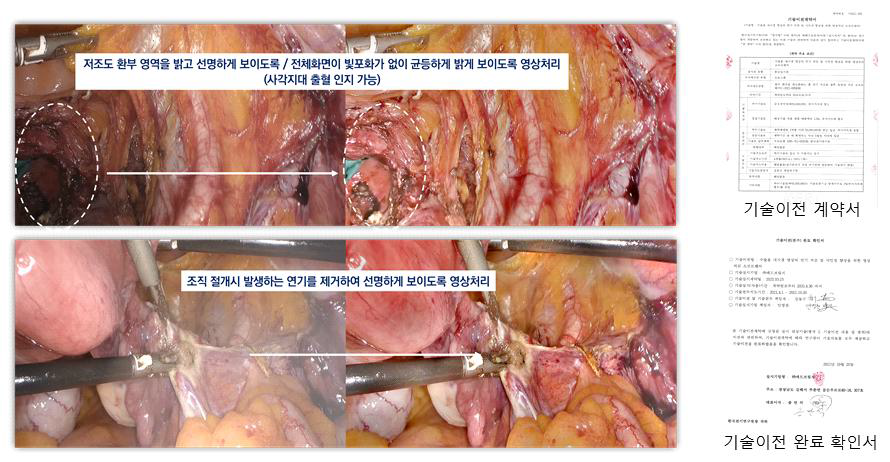 수술용 내시경 시각강화 기술 적용 전 후 비교