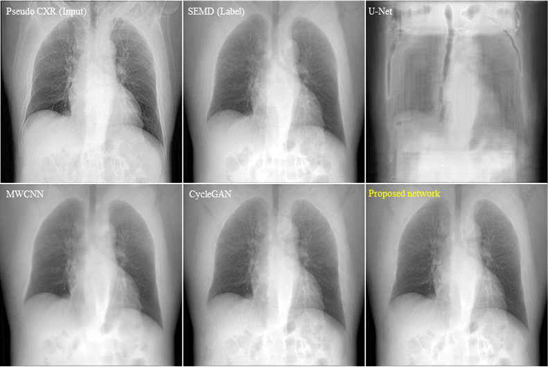 다양한 인공지능 신경망을 이용한 Bone-suppression 영상들의 비교