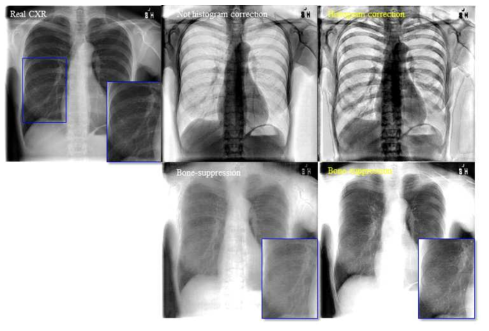 Pseudo X-ray 프로세싱(histogram correction) 전과 후의 실제 흉부 촬영 영상의 테스트 결과