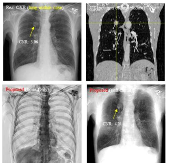 실제 환자의 병변의 제안된 방법의 폐 결절 검출