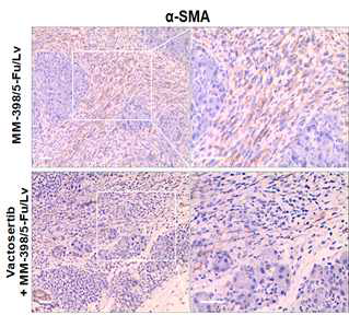 α-SMA 염색을 통한 췌장암 주변 조직의 섬유화 확인