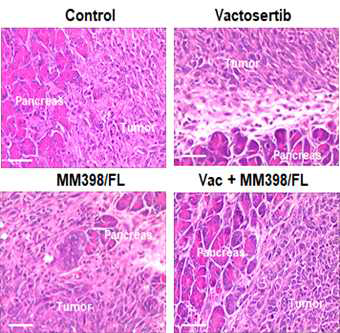 Vactosertib와 MM398/5-FU/LV의 단독 및 병용처리에 따른 암 전이 억제 효과