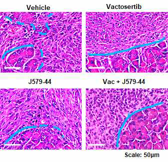 Vactosertib 및 J579-44 병용 처리 시 종양 조직의 침윤 변화