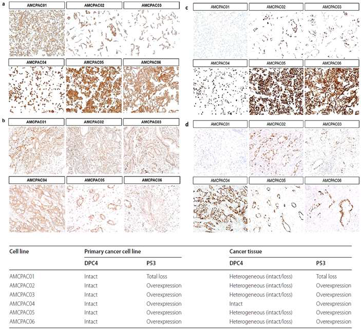 AMCPAC01∼06 세포주와 환자조직에서 DPC4와 P53의 발현비교. (A,B) DPC4의 면역염색. (C, D) P53의 면역염색. (A,C) AMCPAC01∼06 세포주. (B,D) AMCPAC01∼06 환자조직