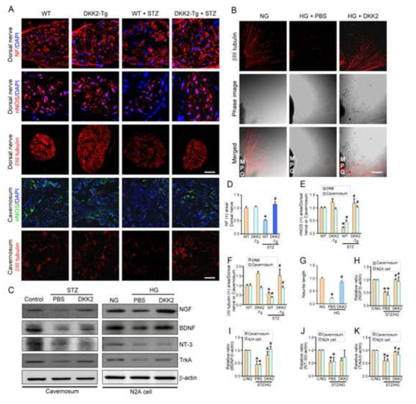 DKK2 overexpression is resistant to diabetes-induced neuropathy