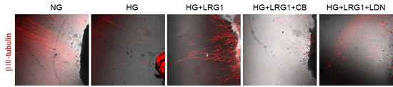 Inhibition of TGFb signaling blocks LRG1-mediated neurite sprouting in cultured mouse major pelvic ganglion (MPG). (주골반신경절을 이용한 실험에서 고 글루코오즈 조건에서 LRG1 단백질에 의해 촉진된 neurite sprouting이 TGFb 신호전달 억제제 [CB, LDN]에 의해 다시 억제됨)