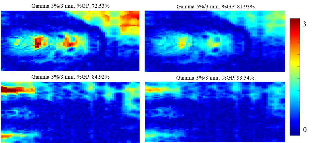 인체모사 팬톰 (3 cm applicator)에서 직장 내 roll-up 기법을 활용한 직장 내벽 선량 측정 결과와 프로그램을 활용한 계산 결과의 gamma evaluation distribution; 위) 3 cm applicator 인체모사 팬톰, 아래) 4 cm applicator 인체모사 팬톰