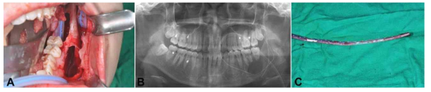 하악골 대부분을 차지하는 큰 병소에서 Z11 골내삽입튜브가 장착된 임상 (A) 및 방사선사진 (B) 모습과 만 7일이 경과한 후에 제거된 튜브 모습 (C)