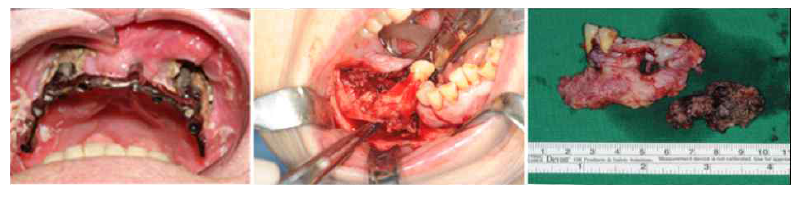 다양한 BRONJ 환자들의 임상적 모습