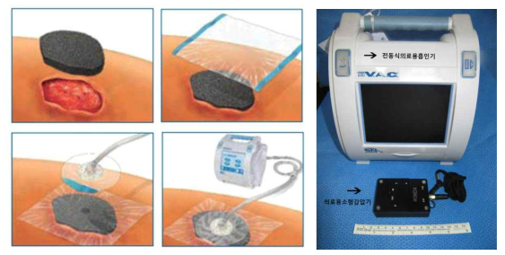 진공음압창상처치 모식도 (좌), 국내에서 사용되고 있는 전동식의료용흡인기와 본 연구에서 개발한 의료용 소형감압기 (우)