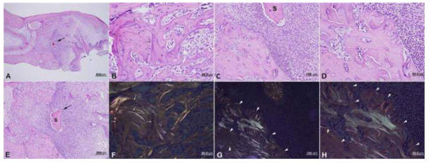 Artificial rat BRONJ lesion treated with no cessation of bisphosphonate therapy. A: Suppurative osteomyelitis with sequestrum (S, arrow) in the central area. E: High magnification of panel A, denoting a sequestrum (s, arrow) floated in suppurative inflammatory exudate. B, C, D: Osteonecrotic bony lesion with multiple reversal lines (arrows) and thin rims of immature bone in the periphery of trabecular bones. F, G, and H: Polarizing microscope images of B, C, and D, respectively. The reversal lines (arrows) in panel B showed almost no birefringence in panel F. The peripheral zone of trabecular bones (arrow heads) in panel C and D showed rare birefringence (arrow heads) in panel G and H