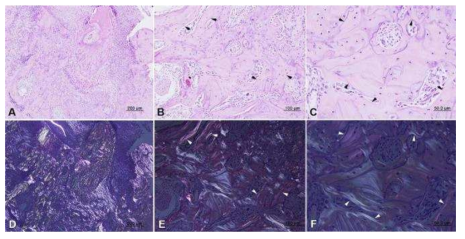 Artificial rat BRONJ lesion treated with cessation of bisphosphonate therapy. The granulomatous bony lesion was gradually organized with active osteophytic new bones. The necrotic exudate in the marrow space was gradually disappeared and replaced by granulation tissue rich in capillaries. A, B, and C were inflamed bony lesion, and they were observed under polarizing microscope in D, E, and F, respectively. The peripheral zone of trabecular bones (arrow heads) in panel B and C showed strong birefringence (arrow heads) in panel E and F