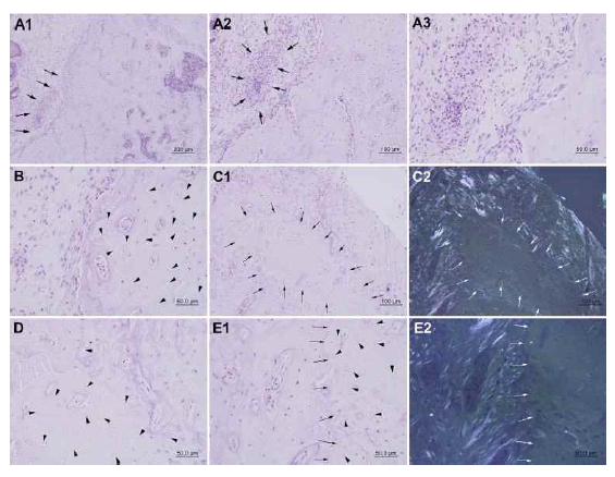 Histological findings with 16 Gy irradiation showing resorption line (A1; arrow), micro abscess (A2,A3;arrow) and dead bone (C1,C2,E1,E2; arrow) with empty osteocytic lacunae (B,D,E1; arrowhead) in the defect site. A1 arrow: resorption line, A2 arrow, A3: abscess border line and abscess area; B arrow head: empty osteocytic lacunae; C1, C2 arrow: dead bone border line; D, E1 arrow head: empty osteocytic lacunae; E1, E2 arrow: dead bone border line