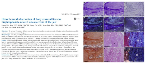 The multiple reversal lines (arrows) of bisphosphonate (BP)-involved bones showed no birefringence. The immature bony matrix of bisphosphonate-related osteonecrosis of the jaws (BRONJ) also showed rudimentary or rare birefringence under the polarizing microscope in the histochemical staining with toluidine blue, Giemsa, Safranin O, van Gieson, and Masson″s trichrome (magnification 20e100 with scale bar). A and B, Toluidine blue staining disclosed multiple reversal lines (arrows) in BPinvolved bones (A), which were much thicker and irregularly curved compared to the control bone E and rare birefringence under the polarizing microscope (B). C and D (same section of A), Giemsa staining also disclosed multiple reversal lines (arrows) in BP-involved bones (C), which were much thicker and irregularly curved compared to the control bone (E) and rare birefringence under the polarizing microscope (D). E and F, Toluidine blue staining of ordinary chronic osteomyelitic bone under the polarizing microscope. The reversal lines (arrows) of chronic osteomyelitic bone were thin and linear, and gradually compressed and thinned as the lamellate bone mineralization advanced (E). The reversal lines (arrows) of chronic osteomyelitic bone showed strong birefringence under the polarizing microscope (F). G (same section of A) and H, The multiple reversal lines (arrows) of BPinvolved bone were strongly stained with Safranin O, indicating that they were immature with abundant organic elements (G and H). I and J, van Gieson staining also disclosed immature collagenous bony matrices not only in the reversal lines (arrows) but also in the woven bone matrix of BP-involved bones (#). K and L, Masson trichrome staining in the border area between normal lamellar bone (&) and BP-involved bone (@). The immature woven bone (@) of BRONJ was usually stained blue (K) and showed rare birefringence under the polarizing microscope (L)