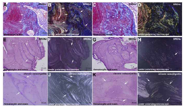 Multiple reversal lines associated with immature woven bone in bisphosphonate (BP)-involved bones compared with none BP-involved osteomyelitic bones of the jaws (magnification 20e100 with scale bar). A and C, Masson trichrome stain. B and D, Under polarizing microscope, the immature woven bones (arrows) in BRONJ. E and G, Hematoxylin and eosin (H&E) stain. F and H, Under polarizing microscope, thick, irregular, and multiple reversal lines associated with immature woven bones (arrows) in bisphosphonate-related osteonecrosis of the jaws (BRONJ). I and K, H&E stain. J and L, Under polarizing microscope, thin reverse lines in noneBP-involved bone of chronic osteomyelitis which were gradually compressed and thinned between osteon structures (arrows)