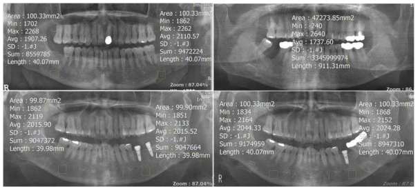 골수염환자의 흑화도 비교 (좌측상단), 한 개의 파노라마에서 최대 및 최소 흑화도 값 (우측상단), 대조군인 정상 환자의 양측부위의 흑화도 비교 (좌측하단), 및 동일 환자에서 다른 시간 촬영한 경우의 비교 (우측하단)