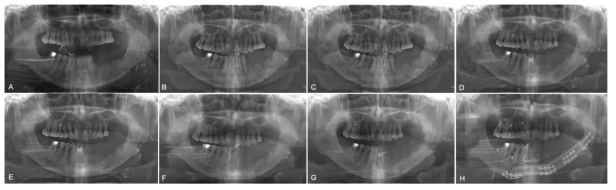 A serial panoramic views of various surgical procedures in the left tongue cancer patient, after glossectomy with radial forearm flap reconstruction state (A), ORN suspicious state after radiotherapy (B), after wound debridement state (C), after sequestrectomy states (D, E), after decortication with seqestrectomy state (F, G), and reconstruction with fibular free flap state (H)