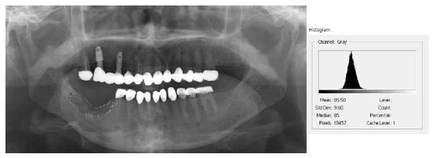 The method used in this study to quantify the densities of defects in the panoramic views. These analyses were performed using Adobe Photoshop CS6®Histogram(AdobeSyste mInc.,SanJose,CA,USA)