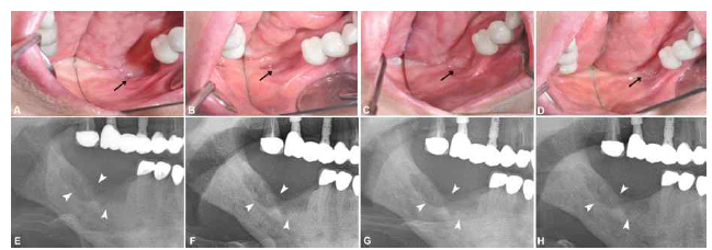 Serial occlusal clinical photos and panoramic views after using PTX and tocopherol in the Case No. 2 patient who had not undergone any surgery and had taken medication for ORN for 315 days, A,E; Before prescription, B, F; Three months after drug administration, C, G; Six months after drug administration, D, H; One year after drug administration