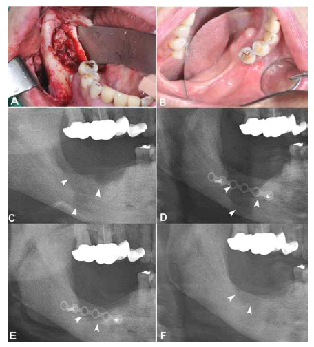 Serial radiographic changes with clinical photos after using PTX and tocopherol in the Case No. 10 patient who began PTX and tocopherol after surgical wound healing for treatment of BRONJ for 8 months, A. Clinical picture showing the pathologic lesion before surgery, B. One year after surgery and drug administration, C. Preoperative panorama showing the lesion extending to the mandibular border, D, One week after surgery, at the beginning treatment of PTX and tocopherol, E; Six months after drug administration, F; One year after drug administration