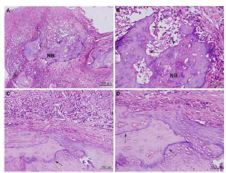 Histopathologic photomicrographs of the BRONJ lesion. The involved bone was severely resorbed in the absence of osteocytes in their lacuna spaces and became necrotic (NB) and sequestered (a). In the high magnification of a, the dead bone was severely resorbed by the decomposition of its bony matrix with marked infiltration of inflammatory cells (b). On the other hand, the osteophytic new bone (arrow) was deposited in the fibrous granulomatous area (c). In the high magnification of c, the newly formed bone was abnormally condensed with immature osteocytes, producing woven bones demarcated by irregular and thick reversal lines (arrows, d)