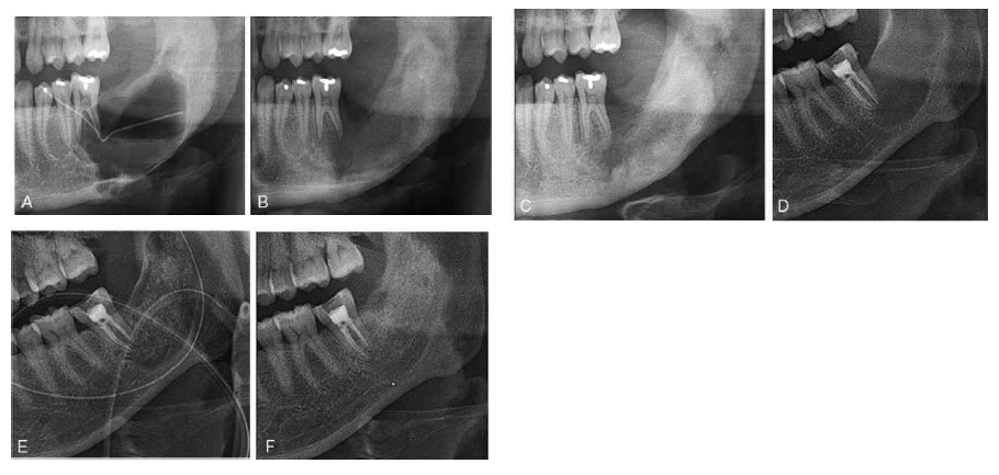 Radiographic views of the bony regeneration process at postoperative day 1 (A), 3 months (B) and 12 months (C) in group 1, and at postoperative day 1 (D), 3 months (E) and 12 months (F) in group 3