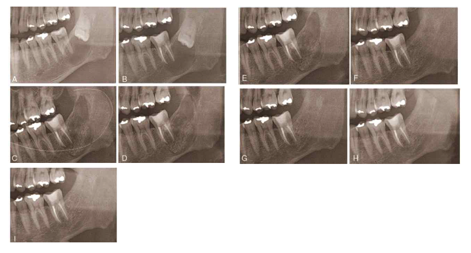 Panoramic views of the bony regeneration process in group 2, preoperative (A), endodontic treatment of involved molar (B), postoperative day 1 (C), 1 month (D) 3 months (E), 6 months (F), 12 months (G), 2 years (H), and 3 years (I)