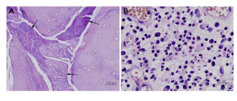 Histopathologic photomicrographs of the infected CSO in patient number 16. The marrow space of the dead bone was filled with bacterial colonies (arrows, A), and suppurative necrotic inflammation with the diffuse infiltration of polymorphonuclear leukocytes, macrophages, and plasma cells in the marrow space (B)